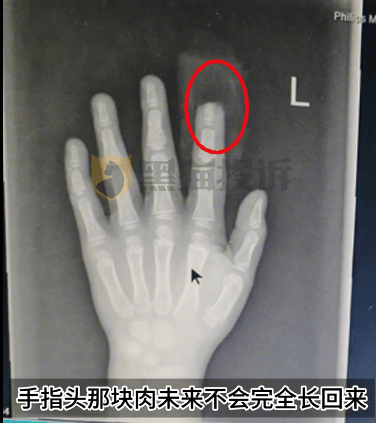 皇冠信用盘代理流程_小鹏汽车回应“X9屏幕夹断5岁男童半节食指”