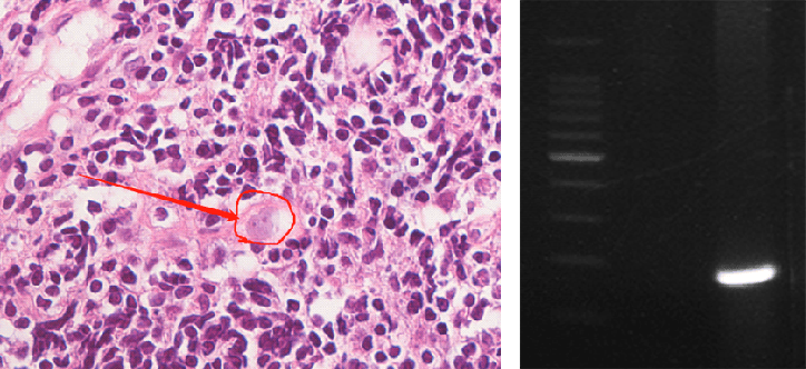 皇冠信用盘登2_上海确诊1例！张文宏团队参与会诊！病死率极高皇冠信用盘登2，发病一周内迅速恶化